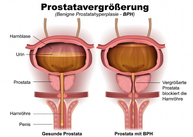 Prostatavergrößerung